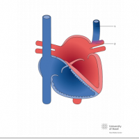 Persistent left superior caval vein draining into the upper left pulmonary vein