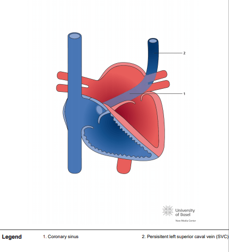 Persistent left superior caval vein