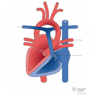 Pulmonary atresia with intact ventricular septum (PAIVS) and situs inversus