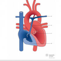 Pulmonary atresia with intact ventricular septum (PAIVS) with hypoplastic right ventricle