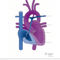 Pulmonary atresia with intact ventricular septum (PAIVS) with hypoplastic right ventricle and cyanosis