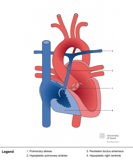 Pulmonary atresia with intact ventricular septum (PAIVS) with hypoplastic right ventricle