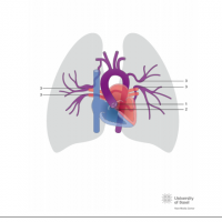 Pulmonary atresia with ventricular septal defect (PAVSD) with major pulmonary-aortic collateral arteries (MAPCA’s)s