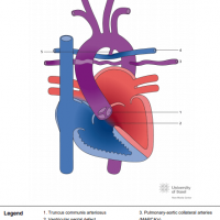 Pulmonary atresia with ventricular septal defect (PAVSD) with major pulmonary confluens