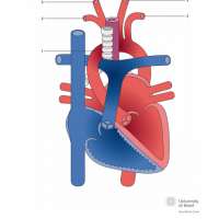 Retroesophagial aortic arch