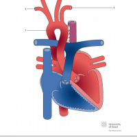 Right aortic arch