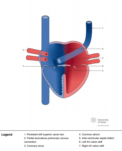 Right atrial isomerism, partial anomalous pulmonary venous connection (PAPVC) and atrioventricular septal defect