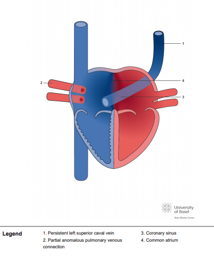 Right atrial isomerism, persistent left SVC and partial anomalous pulmonary venous connection (PAPVC)