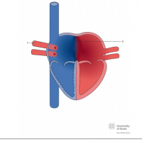 Right atrial isomerism with common atrium
