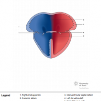 Right atrial isomerism with common atrium and atrioventricular septal defect (AVSD)
