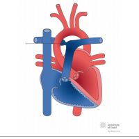 Right pulmonary artery (RPA) stenosis