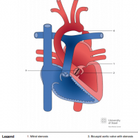 Shone Syndrome