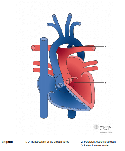 Simple D-Transposition of the great arteries (TGA)