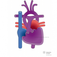 Single ventricle