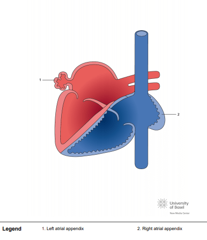 Situs inversus with left and right atrial appendices