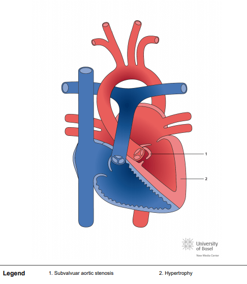 Subvalvular aortic stenosis, membranous type