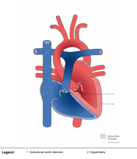 Subvalvular aortic stenosis, muscular type