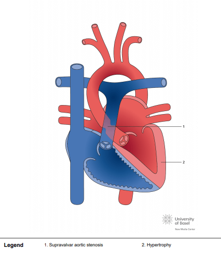 Supravalvar aortic stenosis, focal type