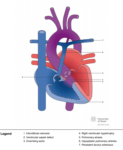 Tetralogy of Fallot (TOF) with pulmonary atresia cyanotic form