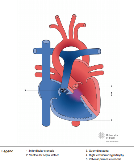 Tetralogy of Fallot (TOF) with pulmonary valvar stenosis; acyanotic form