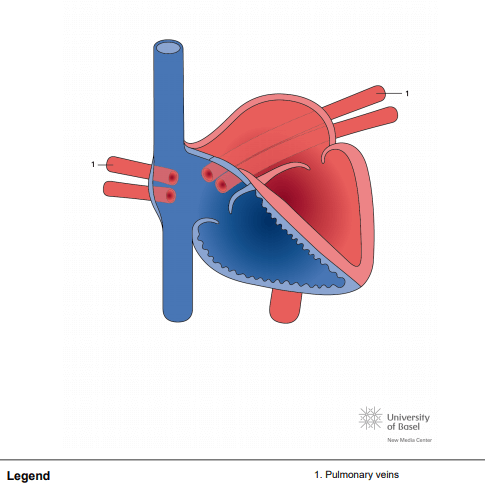 Total anomalous pulmonary venous connection (TAPVC); cardiac type into right atrium (RA)