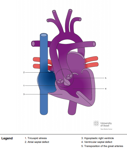 Tricuspid atresia with transposed great arteries (TGA)