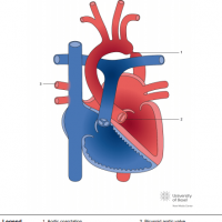 Turner syndrome