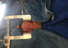 Ascending Aorta Aneurysm undergone Bentall1