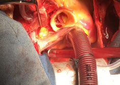 Ascending Aorta Aneurysm undergone Bentall3