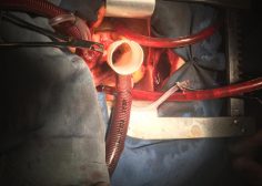 Ascending Aorta Aneurysm undergone Bentall4