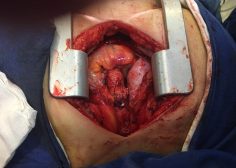 Ascending Aorta Aneurysm undergone Bentall5