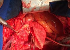 Ascending Aorta Aneurysm1