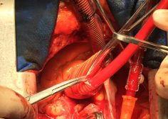 Ascending Aorta Aneurysm2