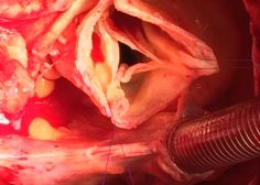 Ascending Aorta Aneurysm3
