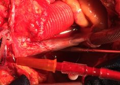 Ascending Aorta Aneurysm4