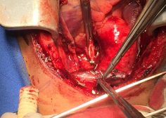Performing central shunt with dacron graft 1
