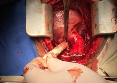 Performing central shunt with dacron graft 2