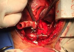 Performing central shunt with dacron graft 3