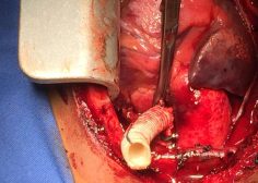 Performing central shunt with dacron graft 4