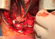 Performing central shunt with dacron graft 5
