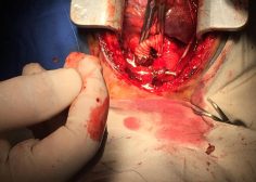 Performing central shunt with dacron graft 6
