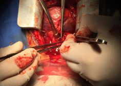 Performing central shunt with dacron graft 7
