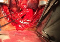 Performing central shunt with dacron graft 8