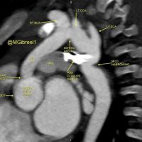 Supravalvular AS, gothic arch, PDA closure device, residual mild isthmic narrowing