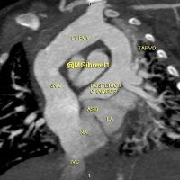 Unobstructed TAPVR supracardiac type