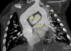 Unobstructed TAPVR supracardiac type1