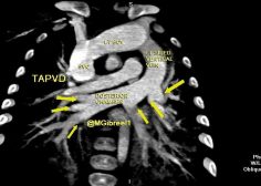 Unobstructed TAPVR supracardiac type2