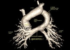 Unobstructed TAPVR supracardiac type3