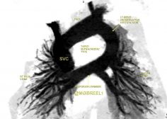 Unobstructed TAPVR supracardiac type4