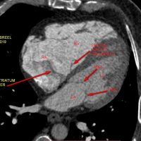 Cor triatriatum sinister & dexter